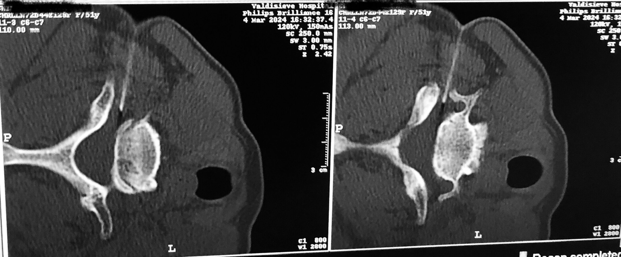 Intraforaminale cervicale Toscana