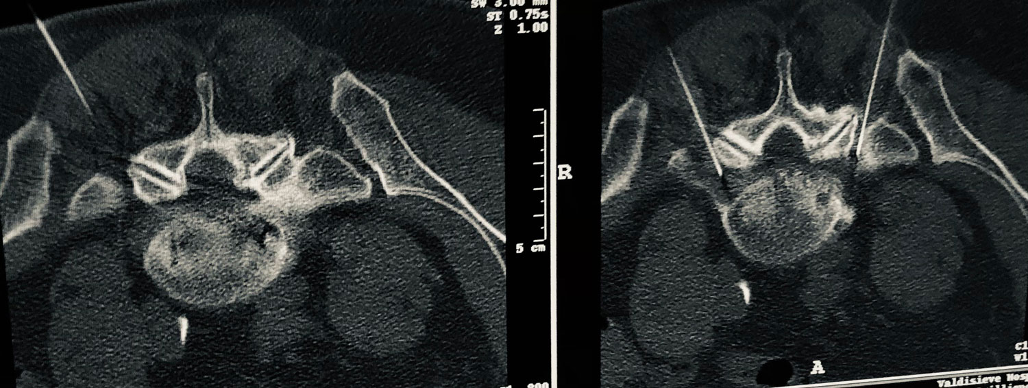 Infiltrazione intraforaminale tac guidata Toscana